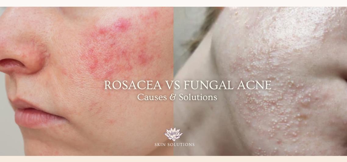 Rosacea or Fungal Acne? Identifying and Treating Outer Conditions through Inner Balance